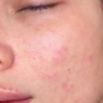 تصویر قبل از درمان