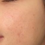 تصویر بعد از درمان