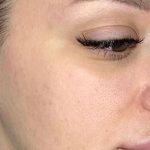 تصویر بعد از درمان