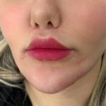 تصویر بعد از درمان