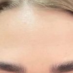 تصویر بعد از درمان